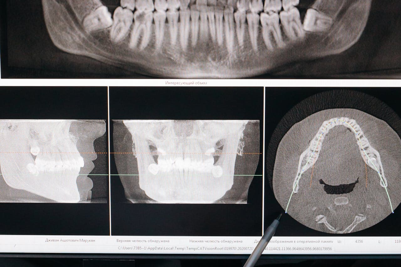 Panoramic dental X-ray showing the jaw and molars